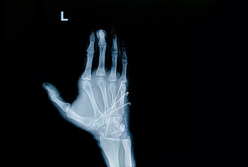 Film x-ray of hand fracture : show fracture metacarpal bone inse