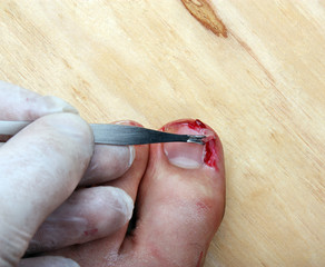 Broken bleeding finger nails