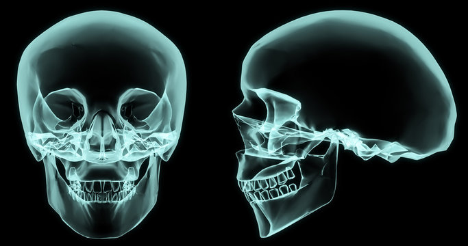 X-ray skull