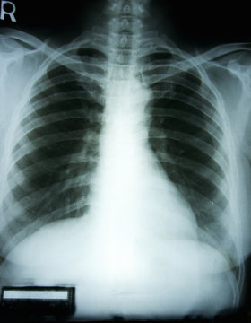 X-ray film of woman chest