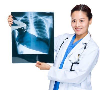 Woman doctor with x ray chest
