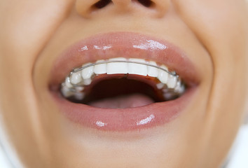 Beautiful smiling girl with retainer for teeth, close-up - obrazy, fototapety, plakaty