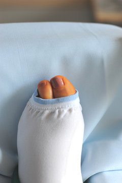 Gipsbein in Krankenbett