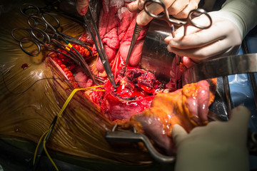 open abdominal aortic aneurysm and stop bleeding