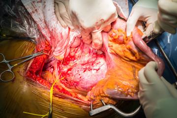 abdominal aortic aneurysm