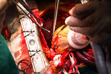 coronary artery bypass grafting obtuse marginal artery anastomos