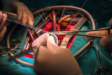 suture valve ring in mitral valve repair