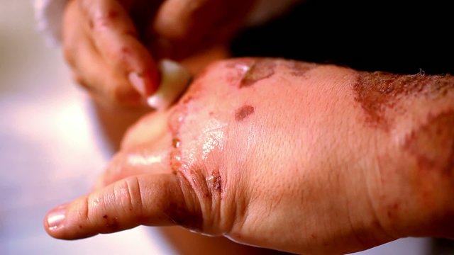 cleaning wounds burns and abrasions on his swollen hand