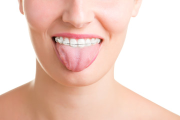 Braces