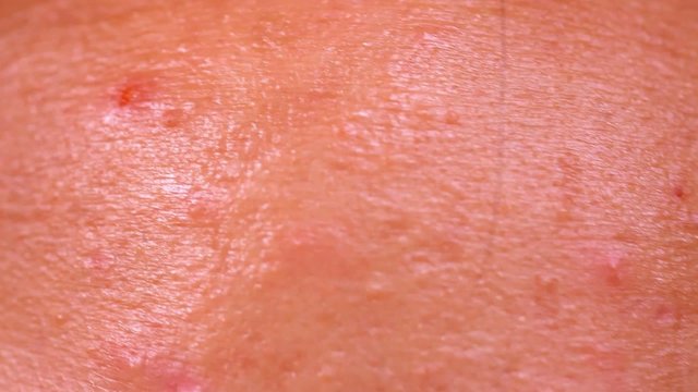 Close up of Acne skin because the disorders Of sebaceous glands