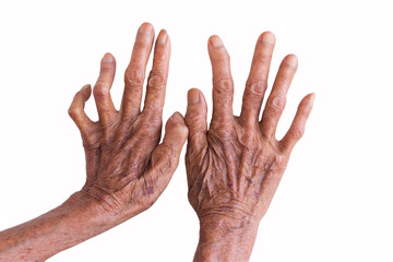 hands of a leprosy isolated on white background