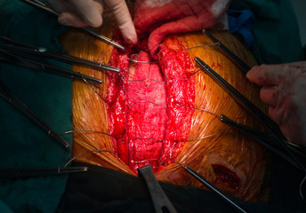 closure sternum bone with metal wires