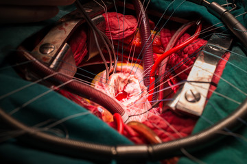 tricuspid valve repair