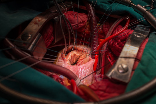 tricuspid valve repair