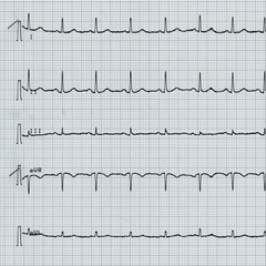 Electrocardiography of heart beat