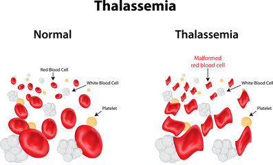 Thalassaemia