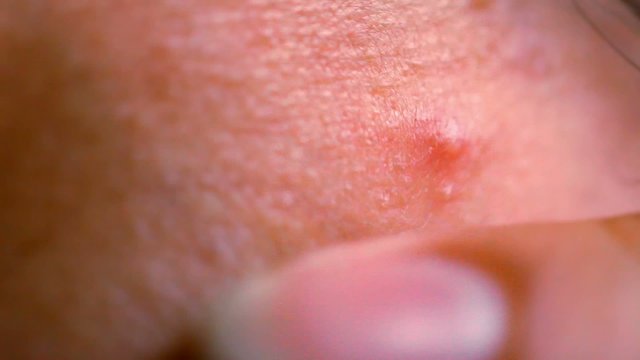 pimple on the skin close-up. Macro video