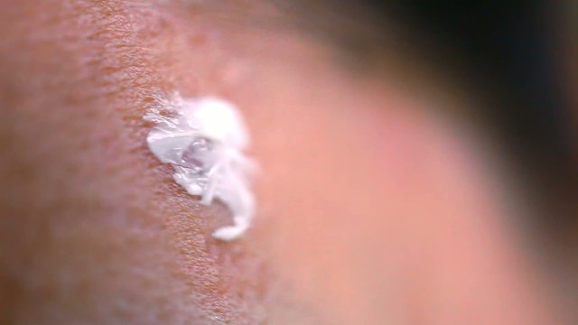 Slurring pimple cream for acne. Macro