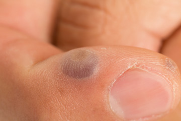 verruca and blister formation after being frozen