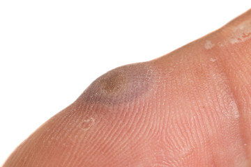 verruca and blister after being frozen