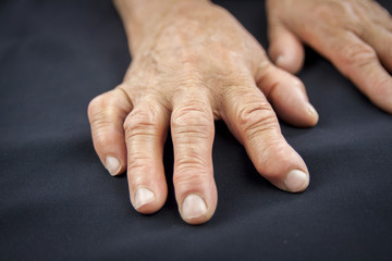 Rheumatoid arthritis hand - obrazy, fototapety, plakaty