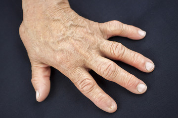Finger without nail