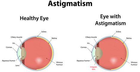 Astigmatism - obrazy, fototapety, plakaty