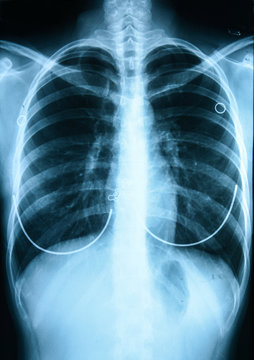 X-Ray Image Of Human Chest 