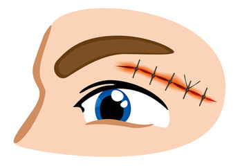 First Aid suture wound eyebrow