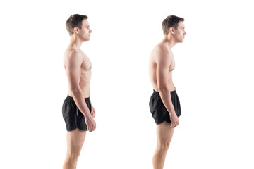 Man with impaired posture position defect scoliosis and ideal - obrazy, fototapety, plakaty