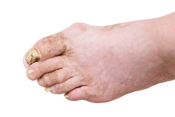 Fungus Infection on Nails of Man's Foot