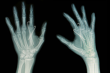 Film x-ray of hand fracture: fracture metacarpal bone