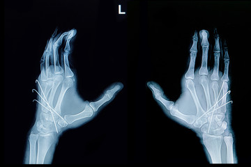 Fototapeta premium Film x-ray of hand fracture : show fracture metacarpal bone inse