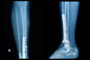 x-ray image of fracture leg (tibia )with implant