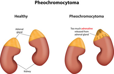 Pheochromocytoma © joshya