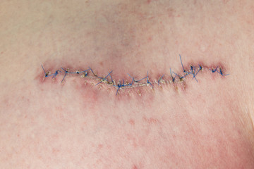 Scar, wound,