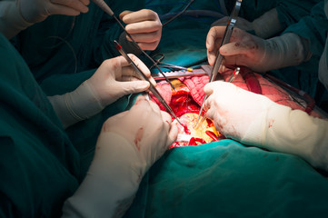 LIMA to LAD anastomosis