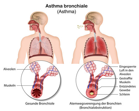 Asthma bronchiale, Bronchokonstriktion Illustration