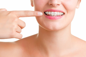 Braces