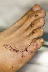 wound and suture