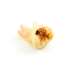 dental caries