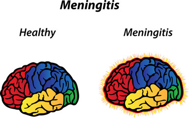 Meningitis