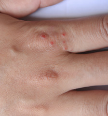 Inflammation of the skin on hands dry skin rash and itching
