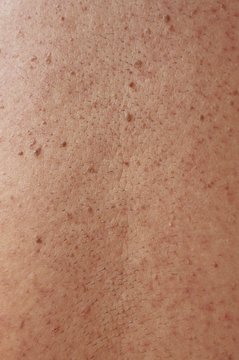 Girl with problematic skin and acne scars in the back