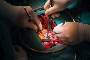mitral valve repair by make neo chordal