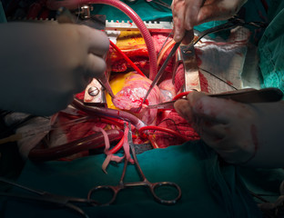 open right atrium