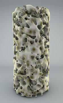 Sezione osso con osteoporosi