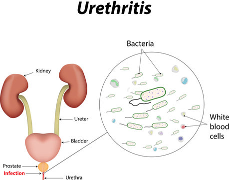 Urethritis