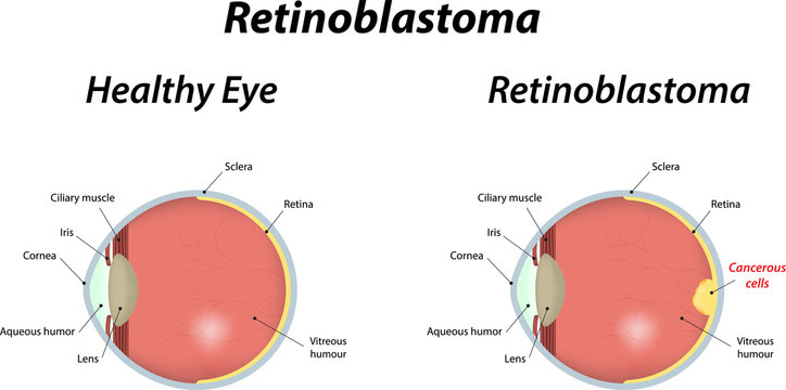 retinoblastoma punnett square