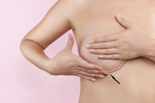 breast augmentation